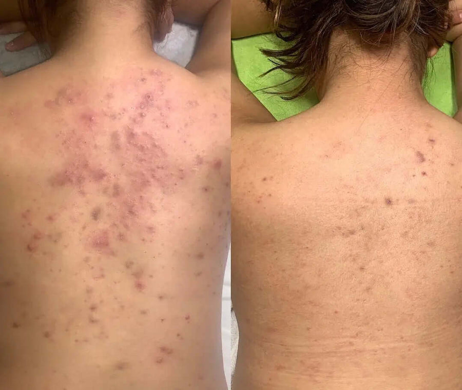 Erba Peel: il peeling a base naturale che rinnova la pelle in profondità