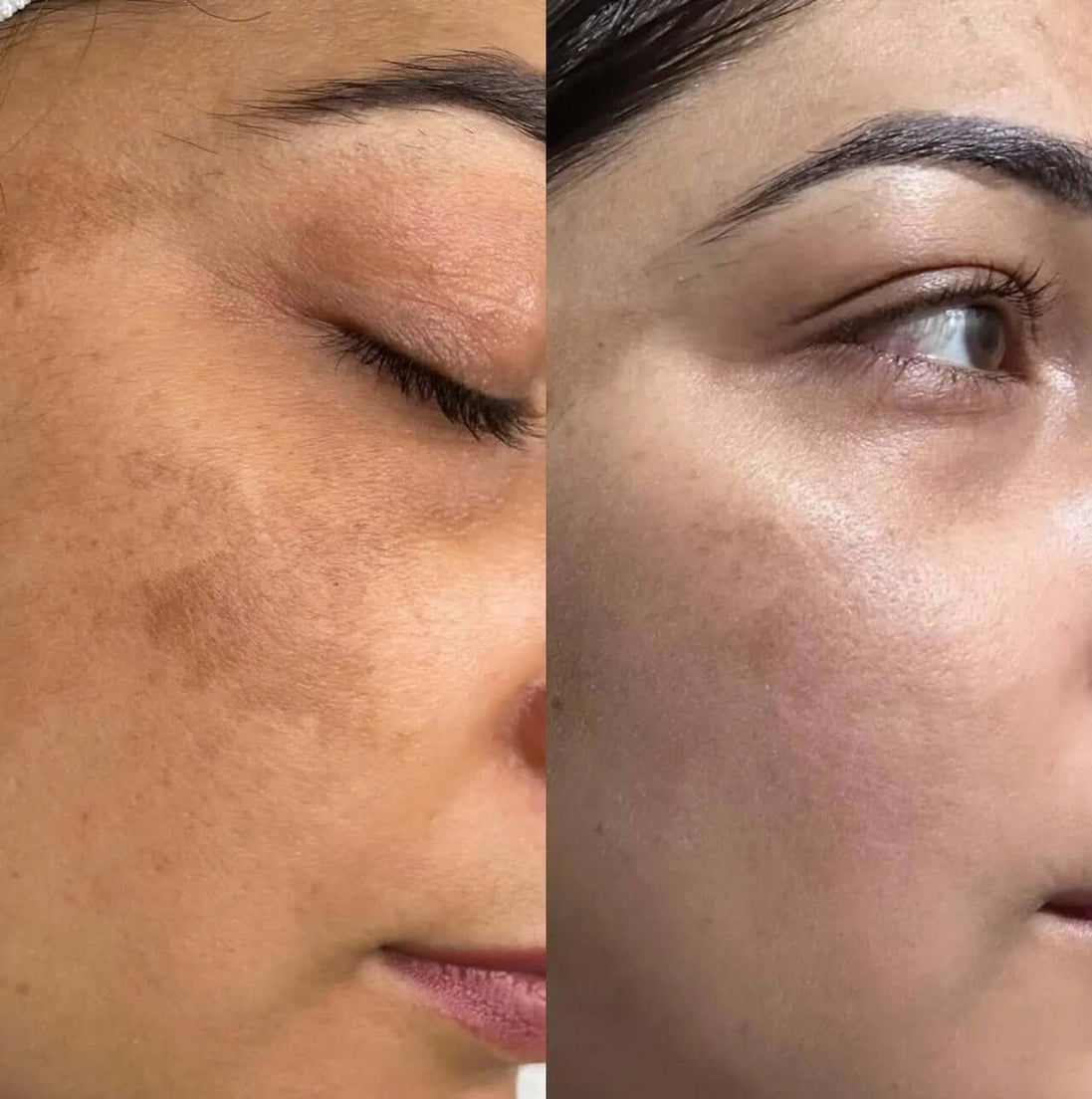 Erba Peel viso - FaceBioma