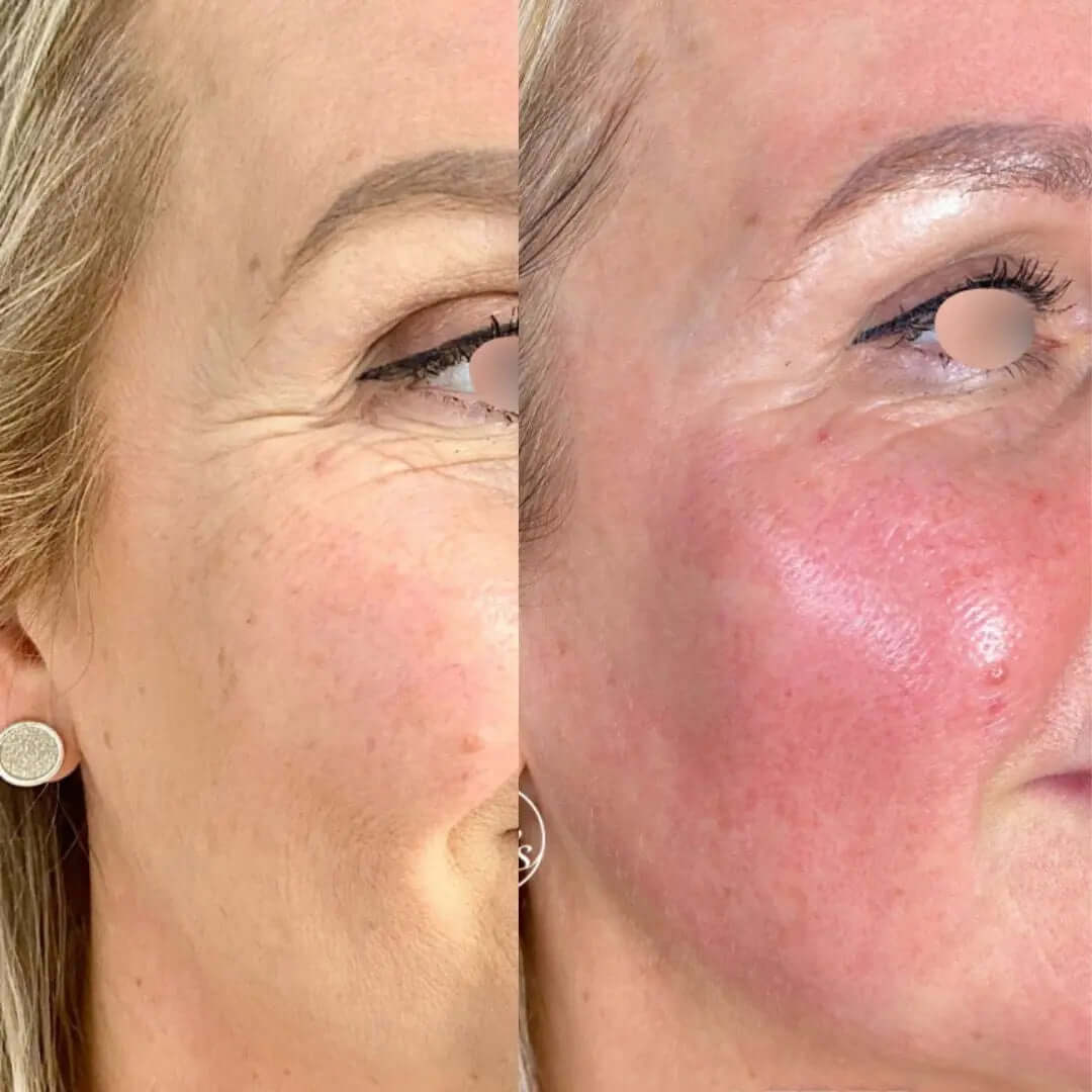 Face Lift - FaceBioma