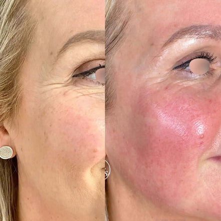 Face Lift - FaceBioma