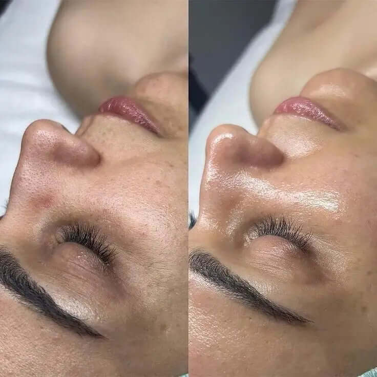 Peeling Classico - FaceBioma