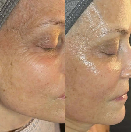 Biolifting: l'alternativa naturale per un viso tonico e giovane
