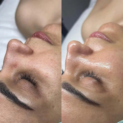 Peeling Antimacchia: il trattamento efficace per una pelle uniforme e luminosa