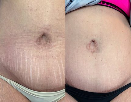 Microneedling corpo: cos'è, a cosa serve e perché provarlo