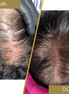 Rinfoltimento Capelli naturali