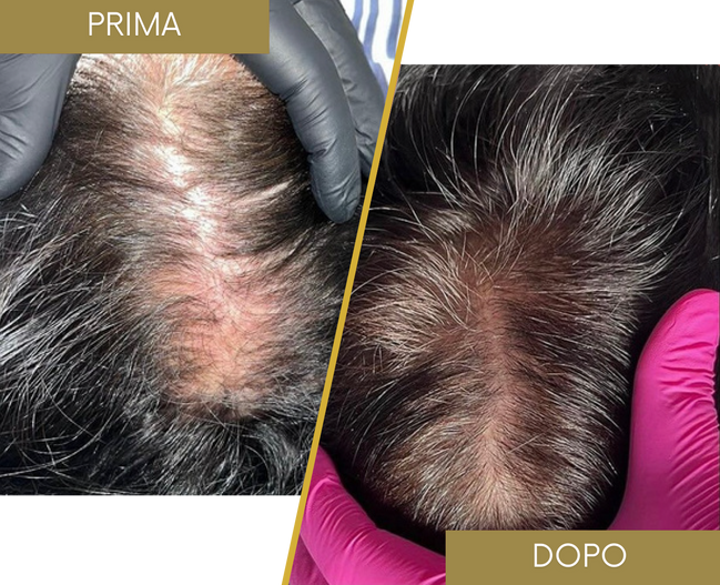 Rinfoltimento Capelli naturali