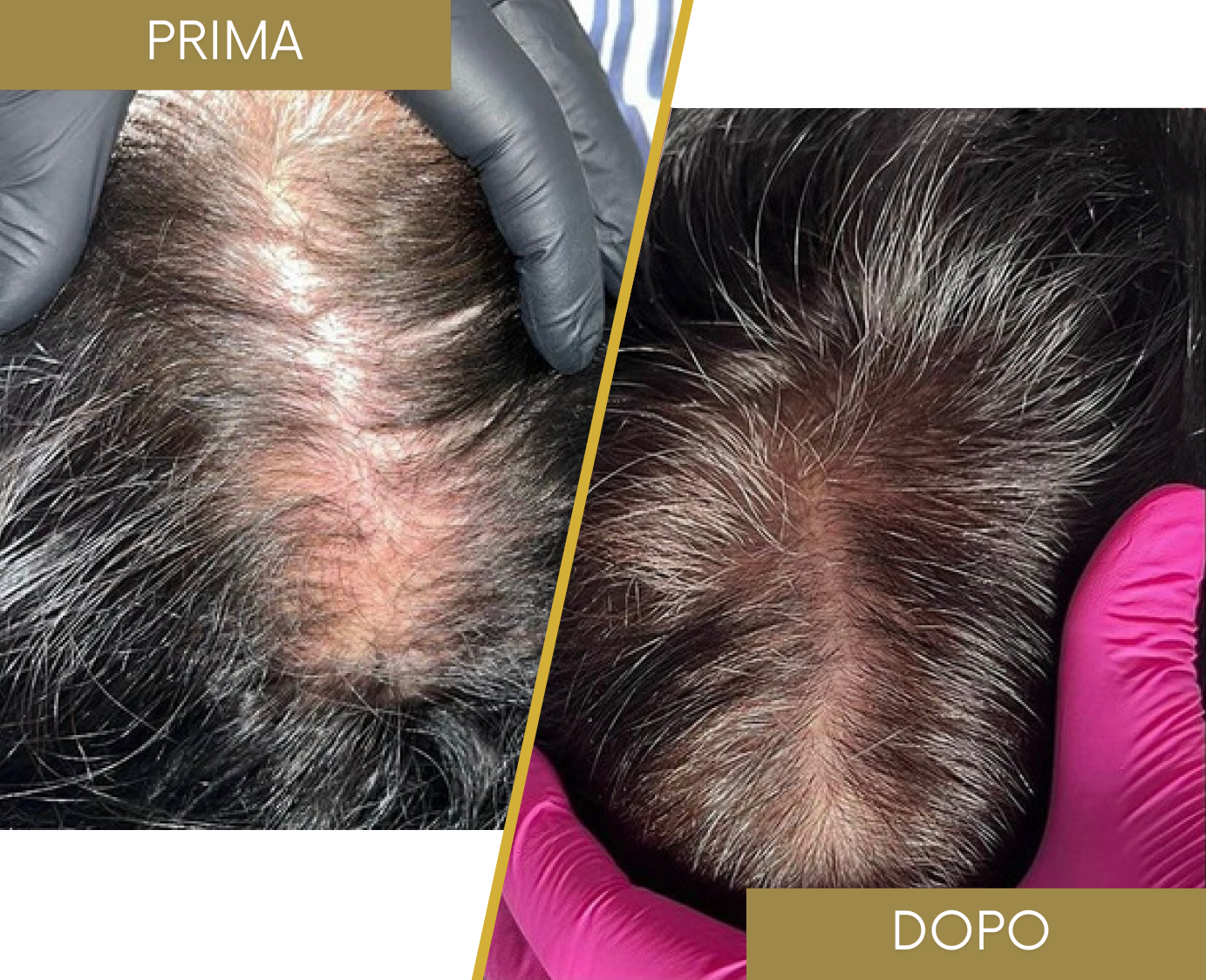 Rinfoltimento Capelli naturali