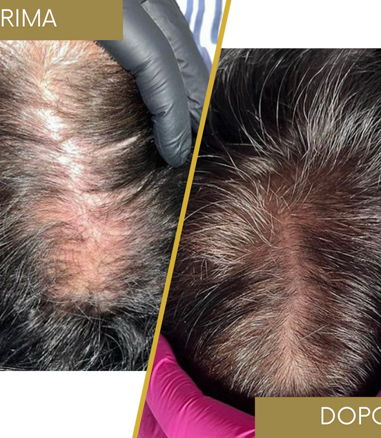 Rinfoltimento Capelli naturali
