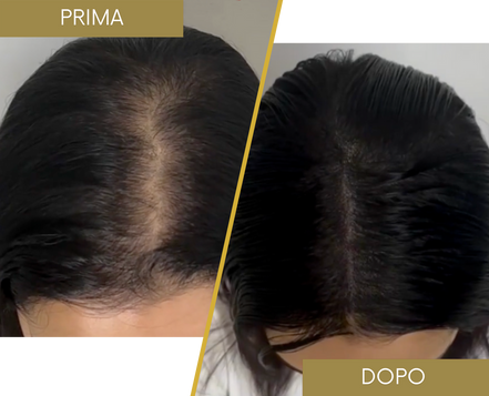 Tricopigmentazione