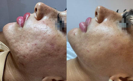 ESOSOMI Microneedling