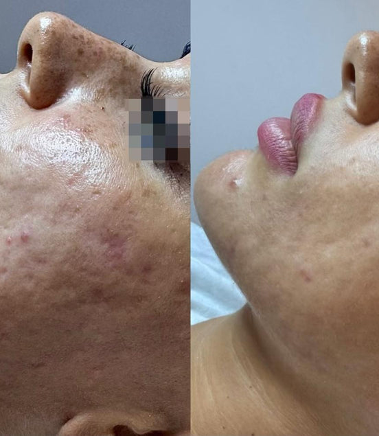 ESOSOMI Microneedling