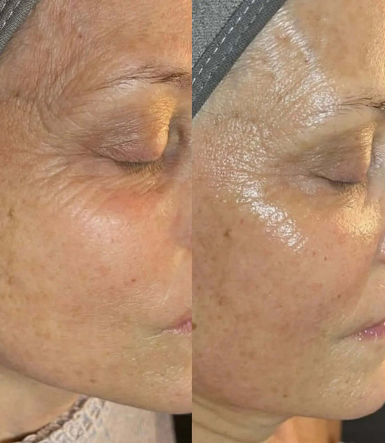 BioLifting - FaceBioma