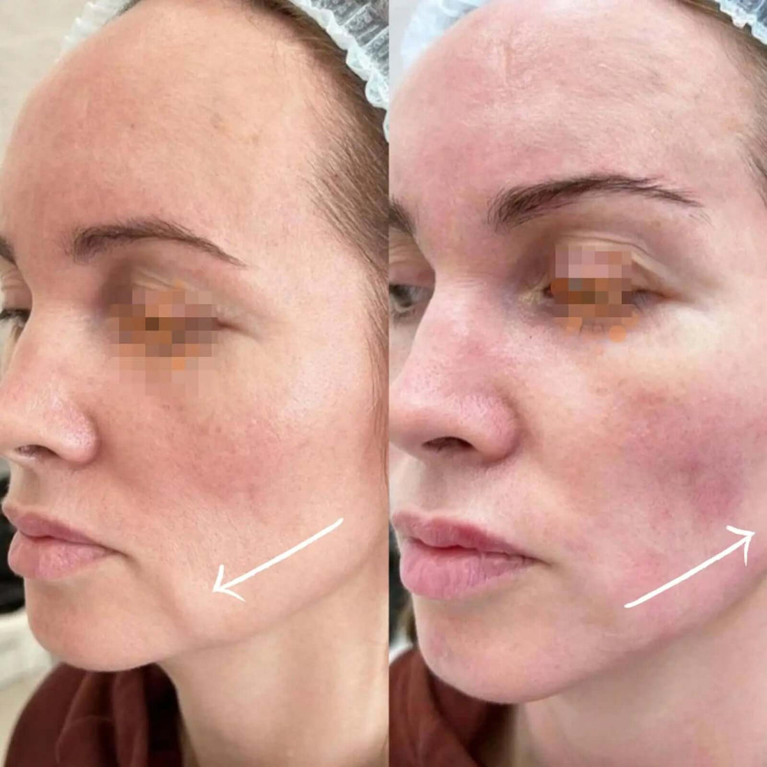 Bioma Face Sculpt (con EMS), Lifting Effect. - FaceBioma