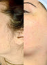 Derma Planing - FaceBioma