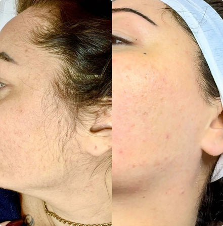 Derma Planing - FaceBioma