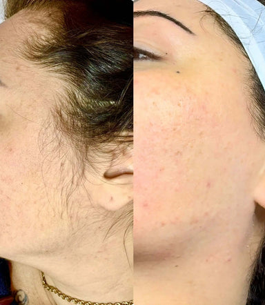 Derma Planing - FaceBioma