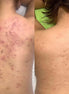 Erba Peel schiena - FaceBioma