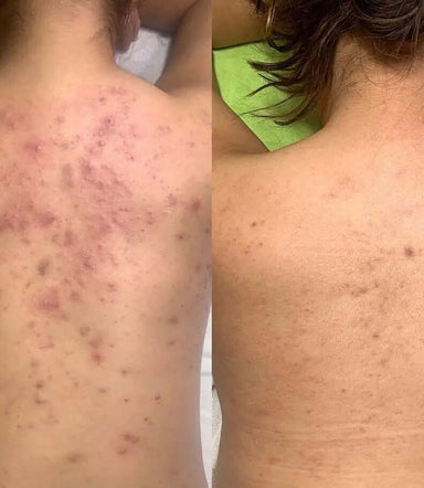 Erba Peel schiena - FaceBioma