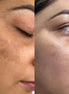 Erba Peel viso - FaceBioma
