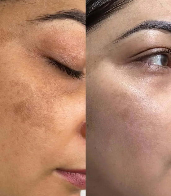 Erba Peel viso - FaceBioma
