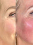 Face Lift - FaceBioma