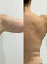 Microneedling Plus Corpo - FaceBioma
