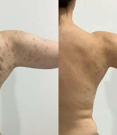 Microneedling Plus Corpo - FaceBioma