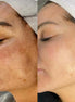 Microneedling Plus Viso - FaceBioma