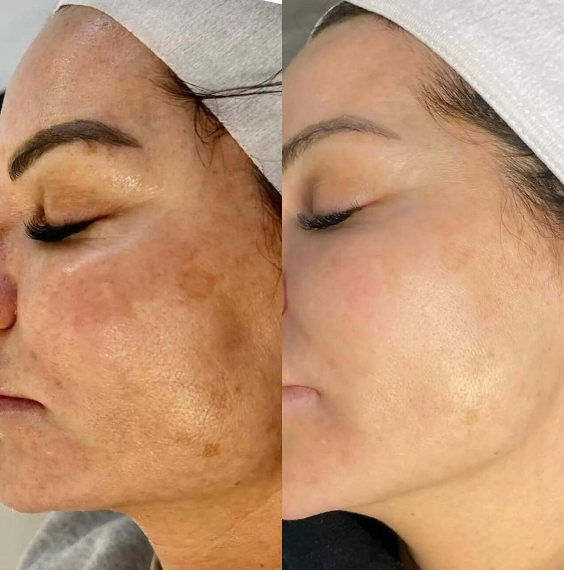 Microneedling Plus Viso - FaceBioma