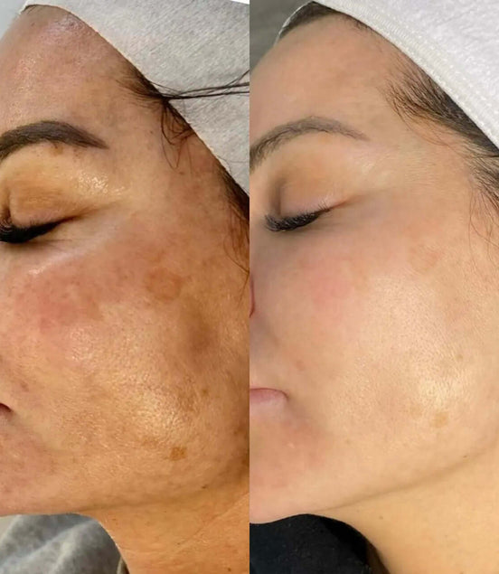 Microneedling Plus Viso - FaceBioma