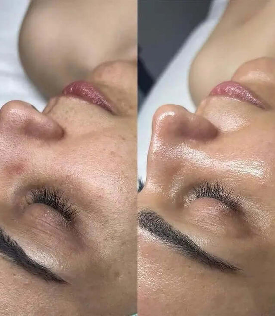 Peeling Classico - FaceBioma