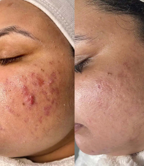 SkinBalance - FaceBioma